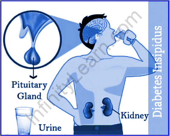 Important Topic Of Biology Insipidus Infinity Learn By Sri Chaitanya