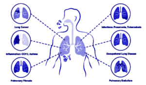 Occupational Respiratory Disorders